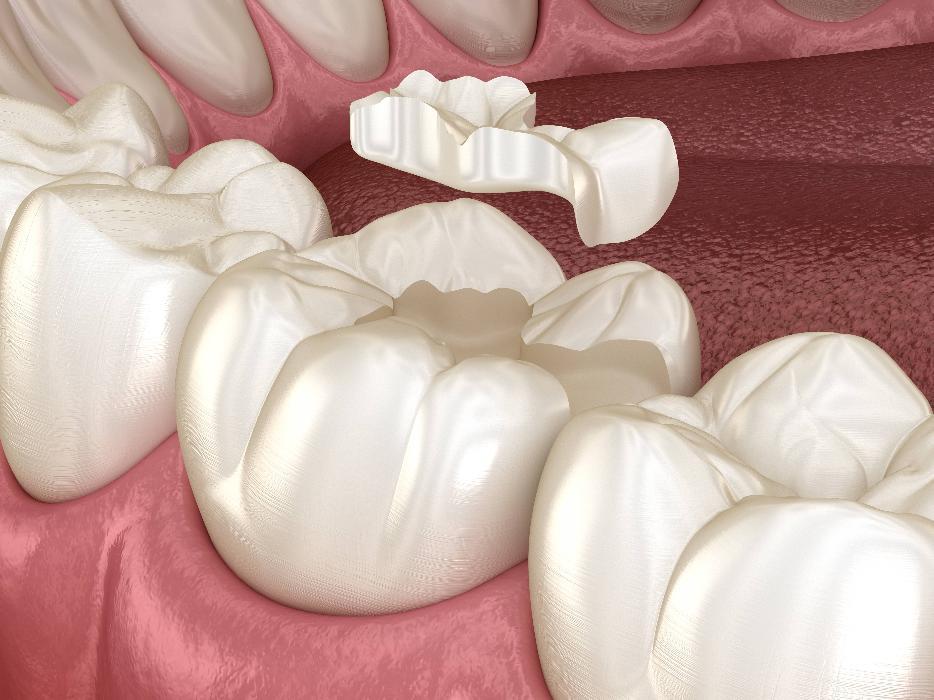 benefits of white composite fillings