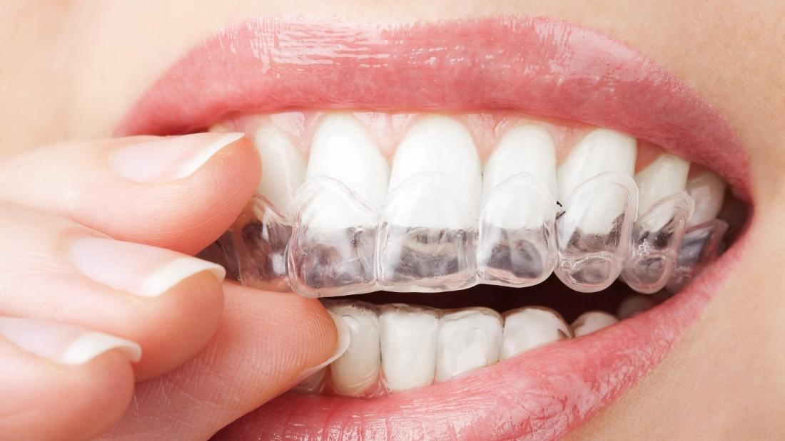 White Park Dental Blog | Is Invisalign Worth It? | Concord NH