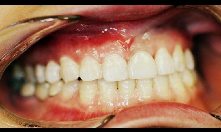 after smile gallery photo | Dental Implants in Concord NH | White Park Dental