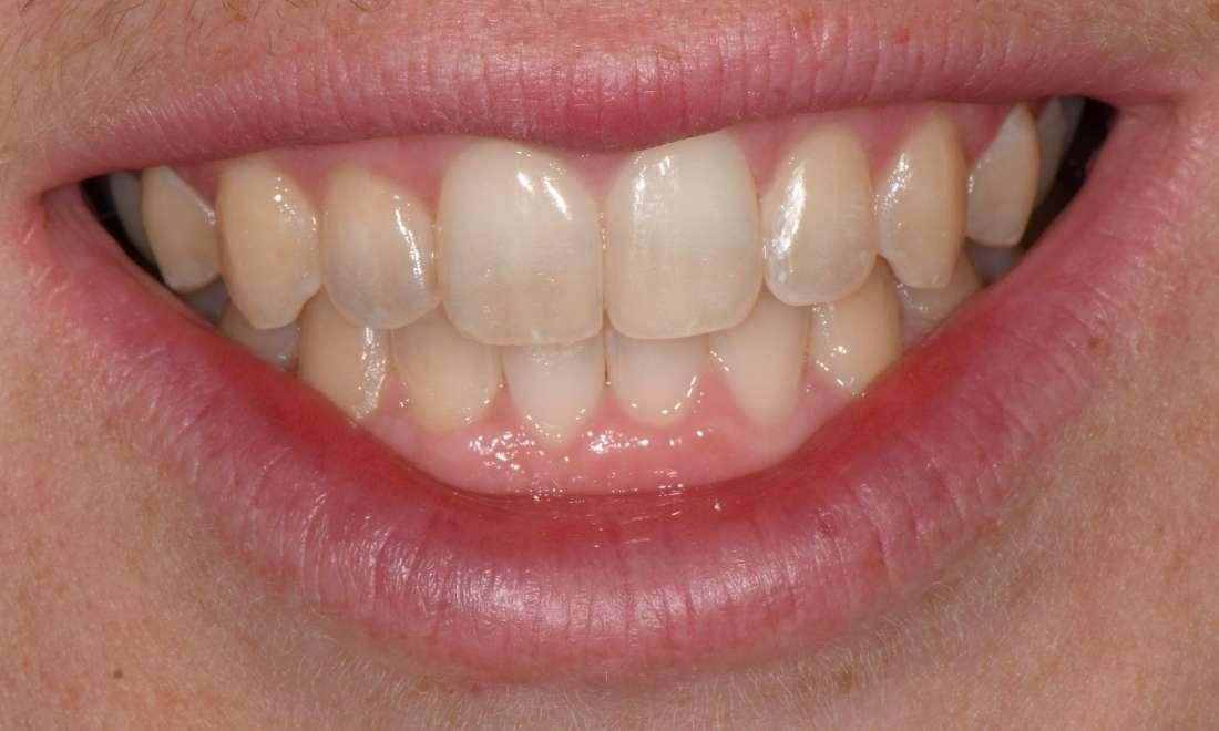 After Invisalign Case