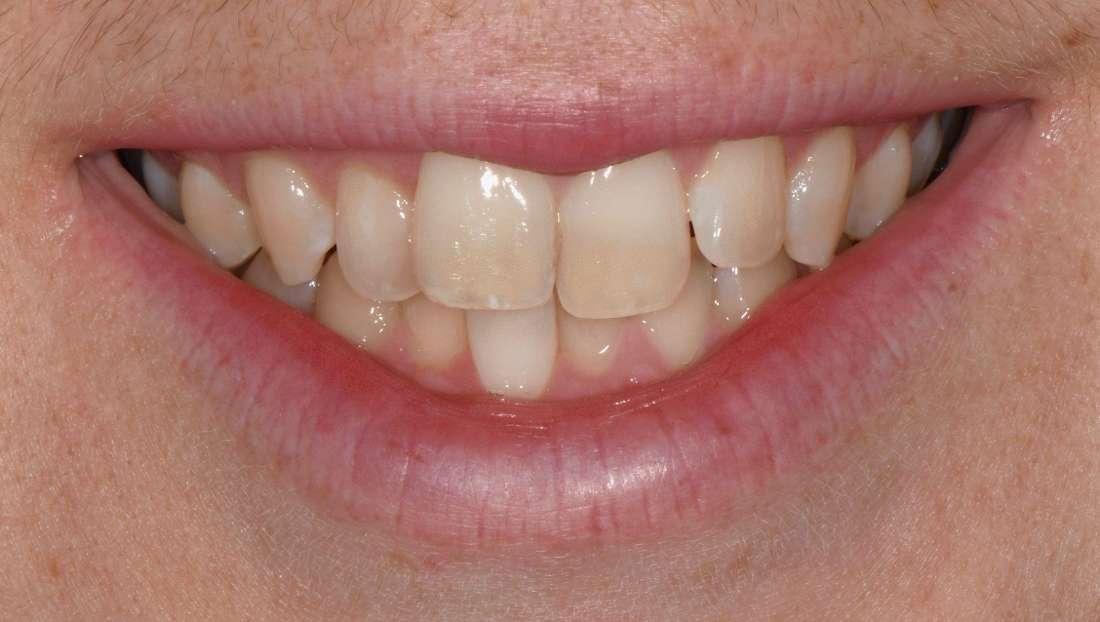 Before Invisalign Case