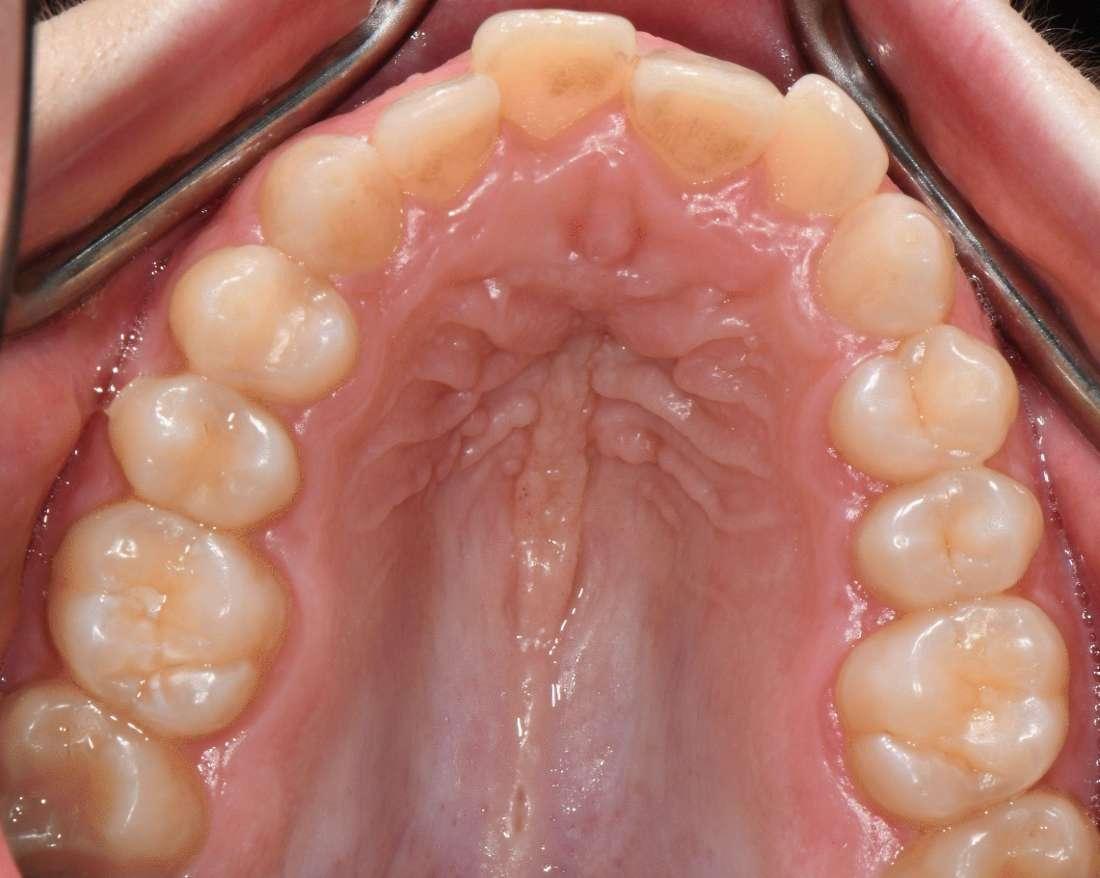 Before Invisalign Case in White Park Dental