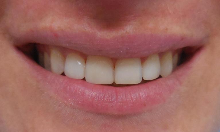 Direct-Composites-White-Fillings-After-Image