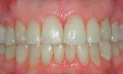 Direct-Composites-White-Fillings-After-Image
