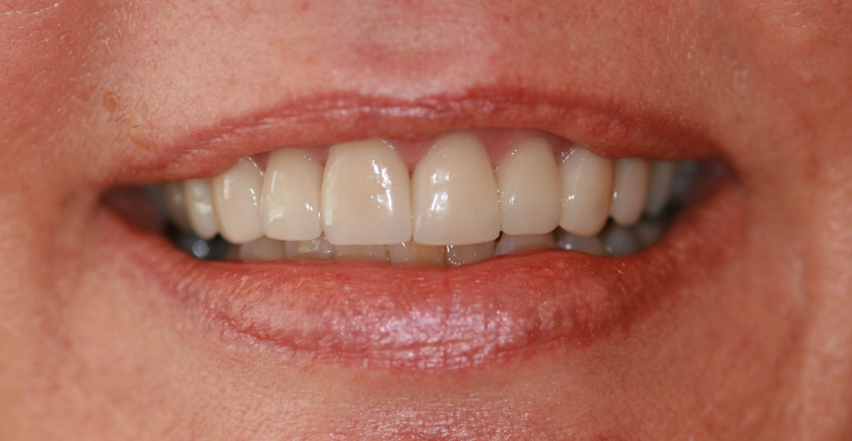 Porcelain-Veneers-Crowns-After-Image