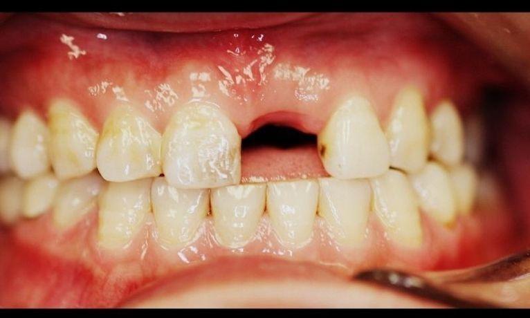 A-Patient-s-Smile-Restored-With-A-Dental-Implant-Before-Image