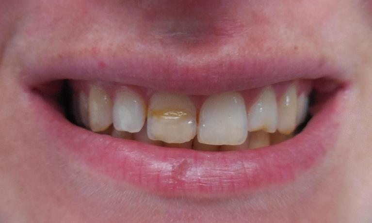 Direct-Composites-White-Fillings-Before-Image