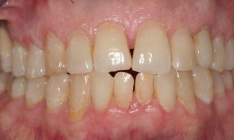 Direct-Composites-White-Fillings-Before-Image