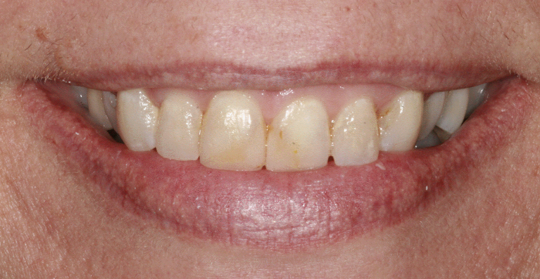 Porcelain-Veneers-Crowns-Before-Image