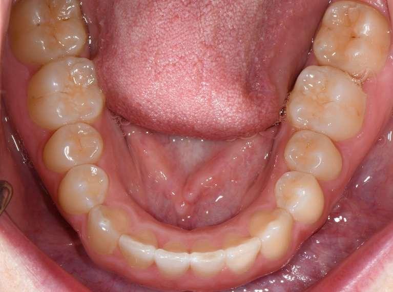 After Invisalign Case in Concord, NH