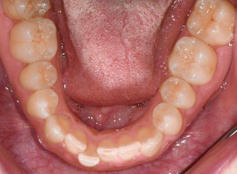 Before Invisalign Case in Concord, NH