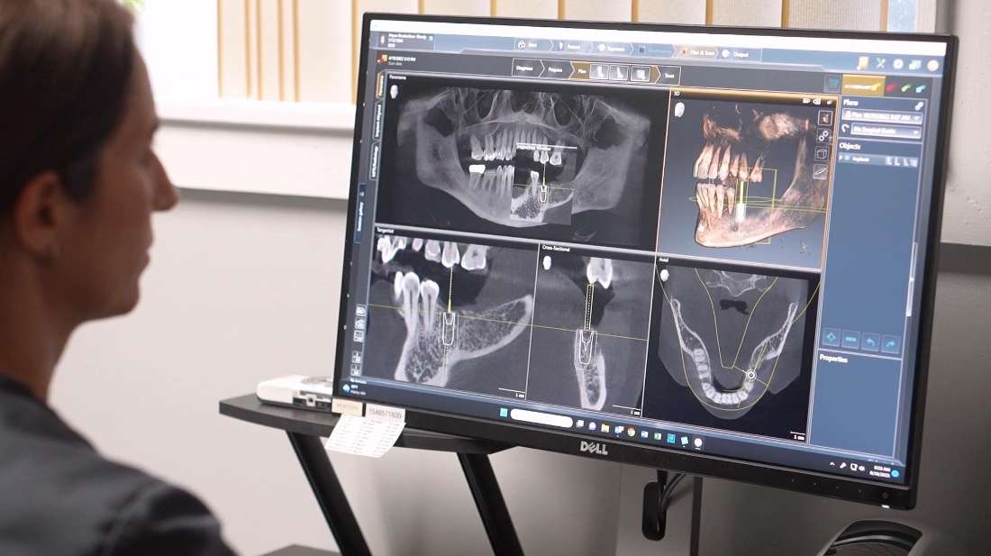 Cone Beam CT Radiography for Implant Treatment Planning